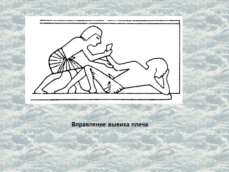 Вправление вывиха плеча